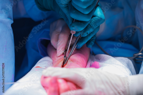 Surgery to restore patient arm in clinic. Surgeon installs metal screw pin to fuse radius bones. photo