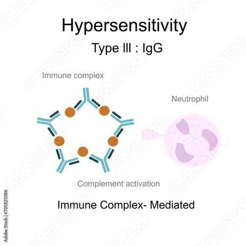 The diagram of Hypersensitivity type lll : Immune complex -Mediated that shows the Immune complex of Antigens and Antibodies indued complement activation , neutrophil and Inflammation Process. photo