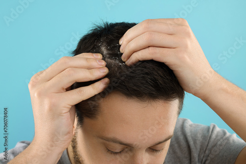 Man with dandruff in his dark hair on light blue background, closeup