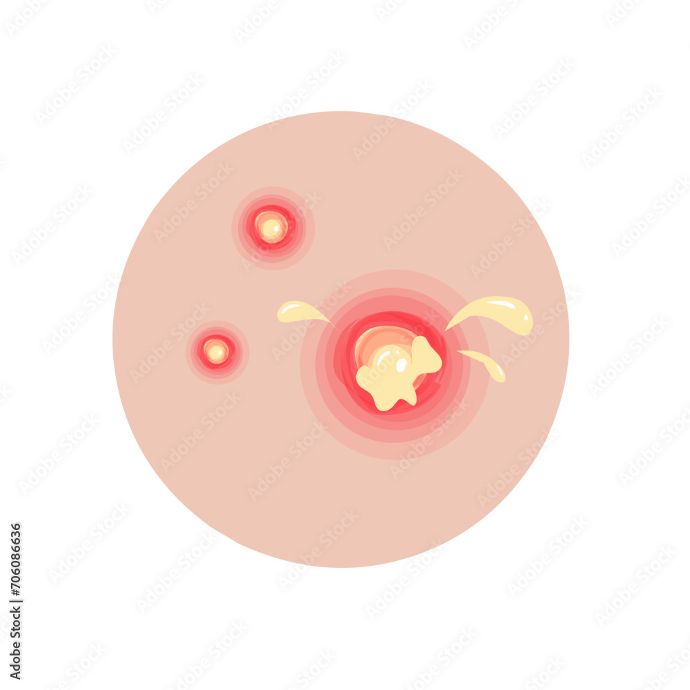 Fototapeta premium Type of acne infographic 