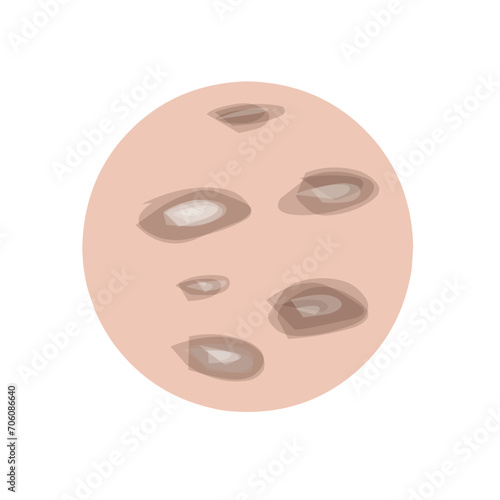 Type of acne infographic 