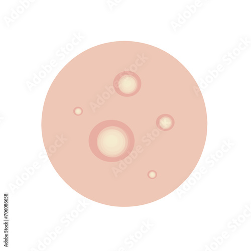 Type of acne infographic 
