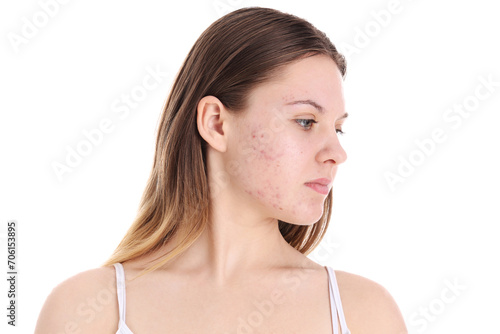 Teenage girl with acne problem on white background, closeup