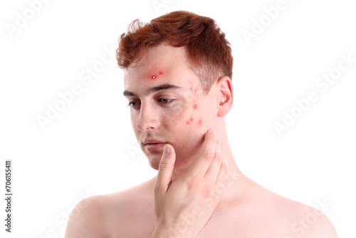Teenage boy with acne on wh...