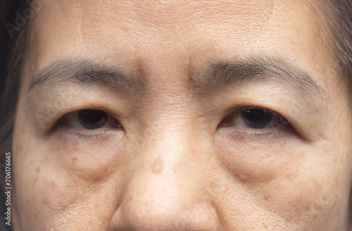 Senior asian woman worry about eye bags and dark spot. photo