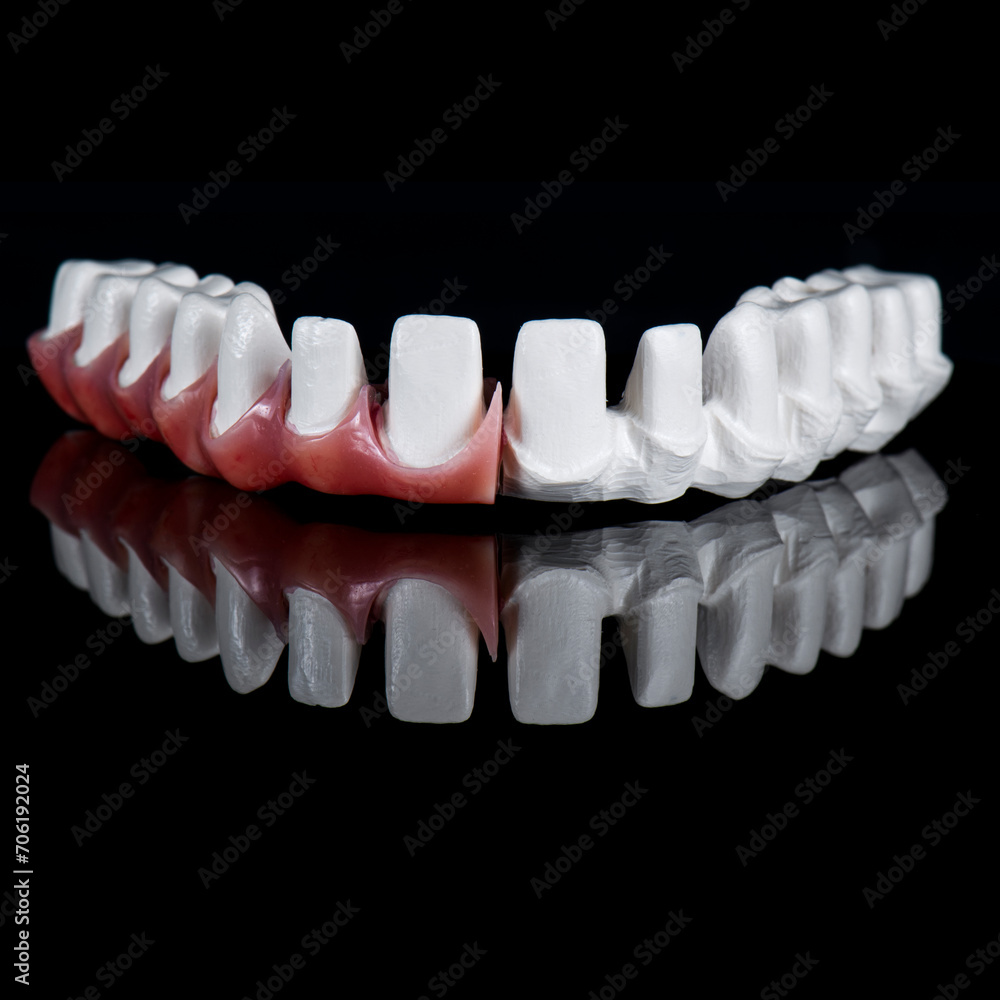 Obraz premium zircon bridge on 8 dental implants