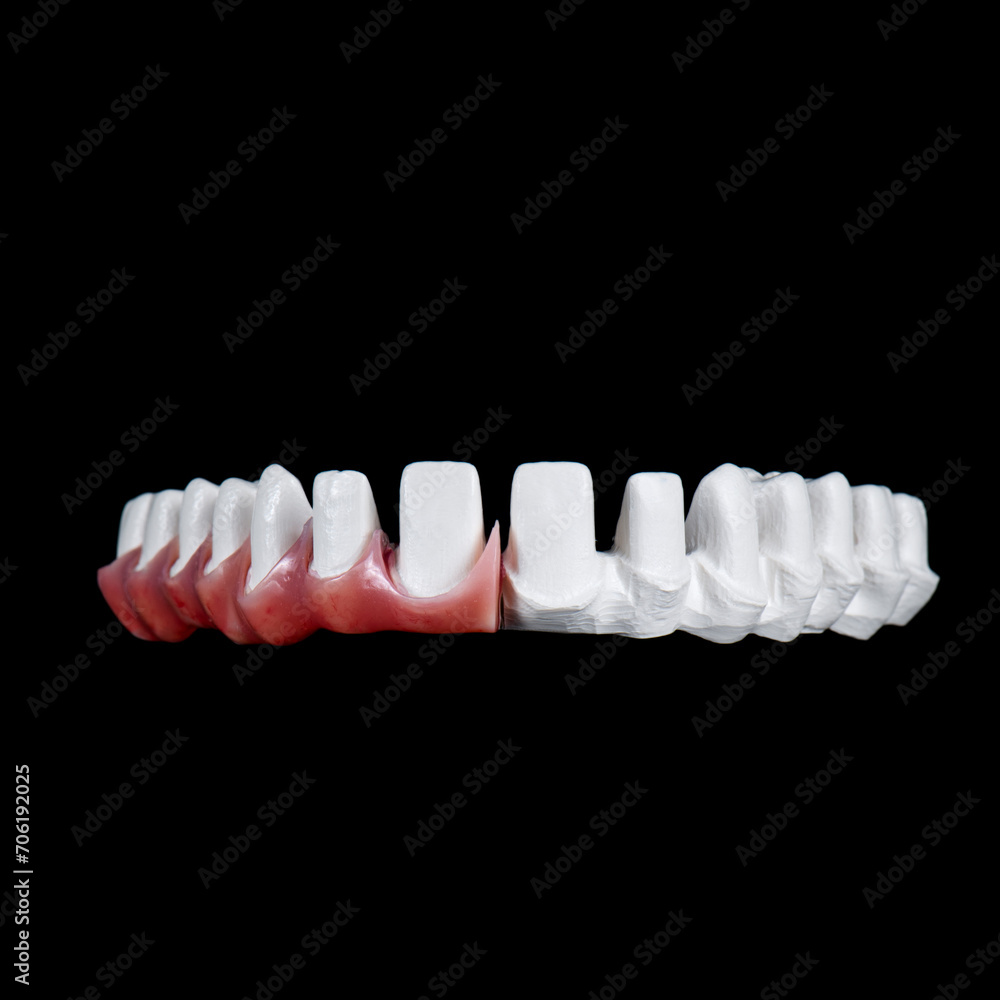 Fototapeta premium zircon bridge on 8 dental implants