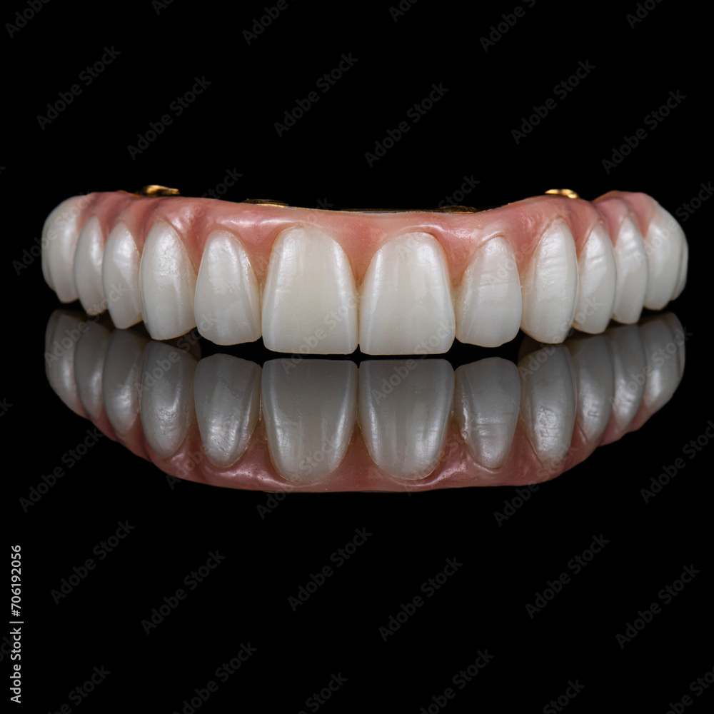 zircon bridge on 8 dental implants zircon bridge on 8 dental implants