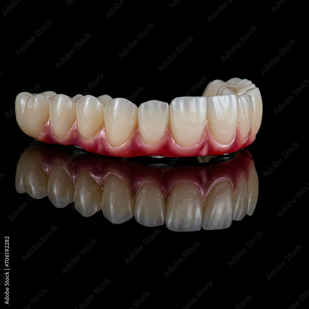 zircon bridge on 8 dental implants zircon bridge on 8 dental implants