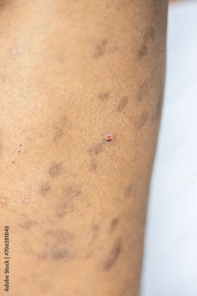 Atopic dermatitis (AD), also known as atopic eczema, is a type of