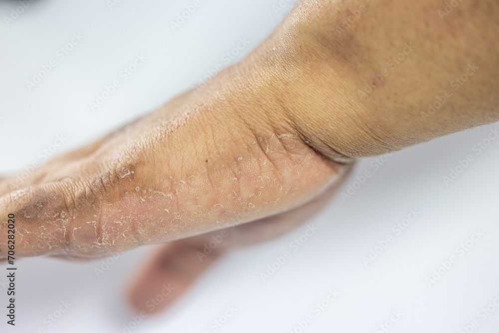 Fototapeta premium Atopic dermatitis (AD), also known as atopic eczema, is a type of inflammation of the skin (dermatitis).