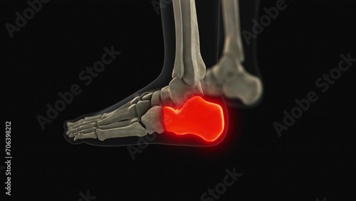Medical animation of the calcaneus bone pain photo