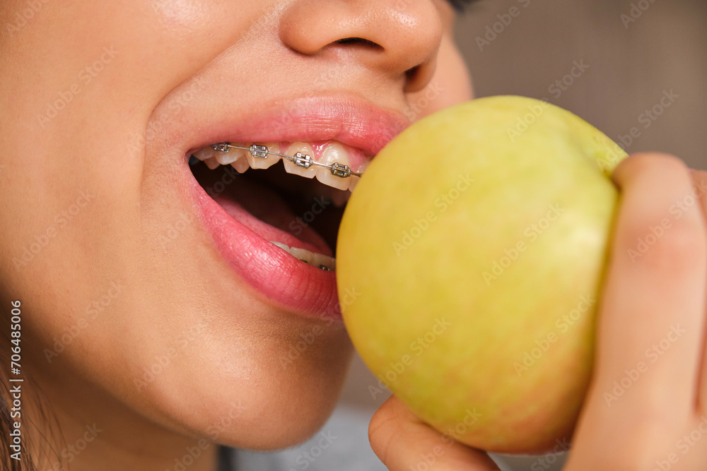 Close up of female teenager mouth with braces eating an apple. Close up of female teenager mouth with braces eating an apple.