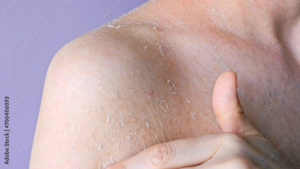 Problematic dry skin on shoulder close-up front view flaking as consequence of dry skin dehydration and dermatitis, concept of health problem dry skin and personal hygiene self care Problematic dry skin on shoulder close-up front view flaking as consequence of dry skin dehydration and dermatitis, concept of health problem dry skin and personal hygiene self care