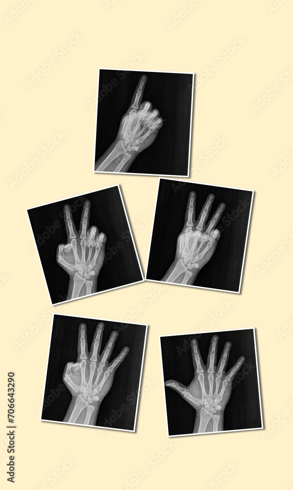 Film xray xray or radiograph of a hand and fingers showing the numbers