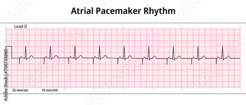 ECG Atrial Pacemaker Rhythm - Single Chamber - 8 Second ECG Paper - Electrocardiogram Vector Medical Illustration