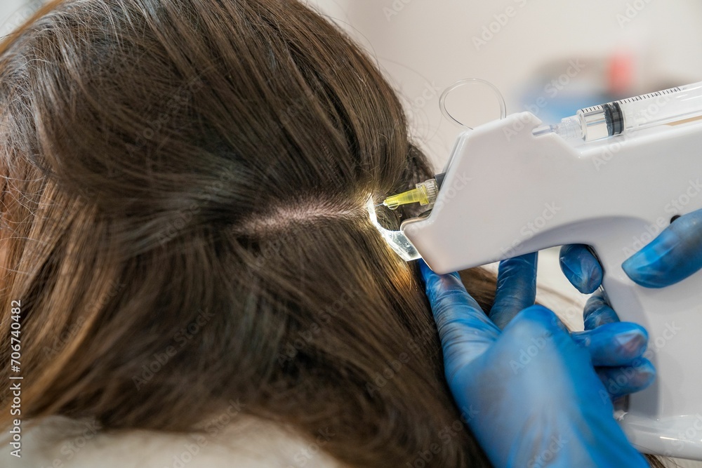 Fototapeta premium Application of capillary mesotherapy treatment to help with hair loss
