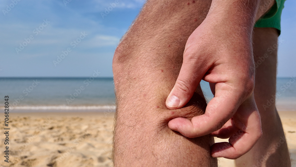 A person pinching their thigh against a beach backdrop, beach fly bites, beach flea bites, possibly illustrating concepts of body awareness or health - obrazy, fototapety, plakaty 