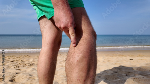 Person on a sandy beach pointing to a leg muscle with beach fly bites, beach flea bites against a backdrop of calm sea, possibly indicating leg pain or muscle injury photo