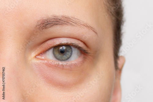 The face of a young woman with a bag under her eye close-up. Swelling of the lower eyelid. Bruises and dark circles appear from insomnia, stress, depression, overwork and fatigue. Unhealthy appearance