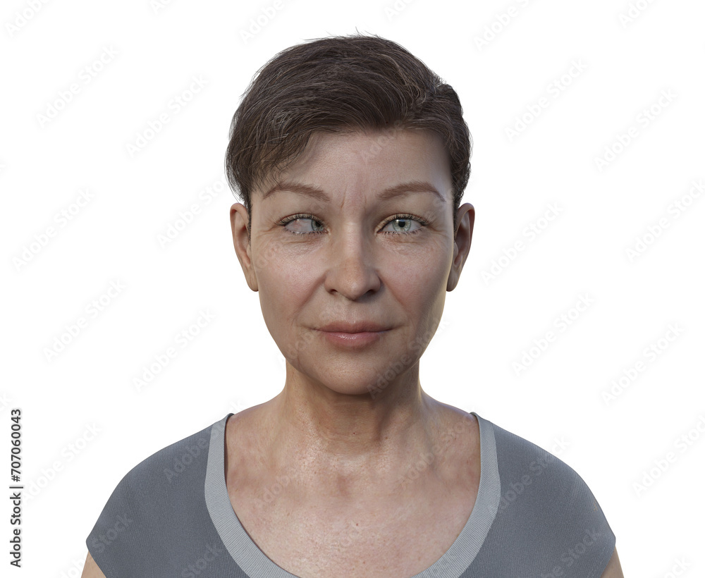 A woman with esotropia, 3D illustration A woman with esotropia, 3D illustration