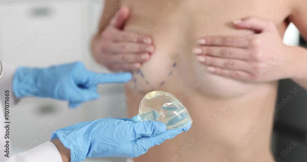 Doctor showing patient with preoperative markings where to inserting breast implant 4k movie slow motion. Breast augmentation plastic surgery concept Doctor showing patient with preoperative markings where to inserting breast implant 4k movie slow motion. Breast augmentation plastic surgery concept
