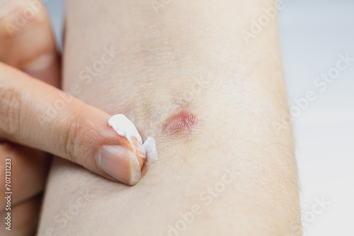 Konstfotografi Woman is applying medicinal cream from Purulent inflammation on the hand in the form of a boil