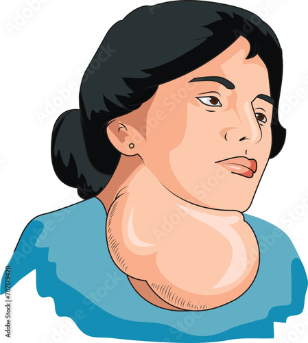 Woman suffering from goitre illustration
