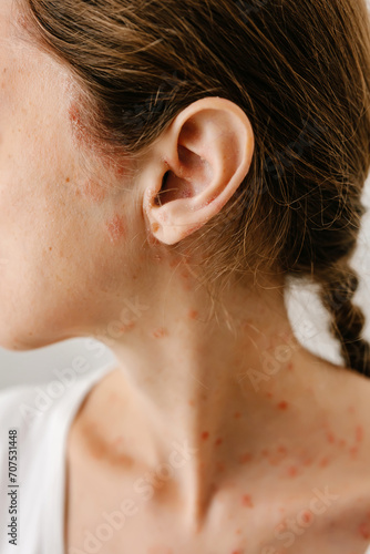 Close-up of the area of the body with affected skin diseases. Manifestations of red spots and scales of dermatitis, eczema, psoriasis on the hairline and scalp.