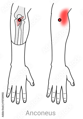 Anconeus: Myofascial trigger points and associated pain locations photo