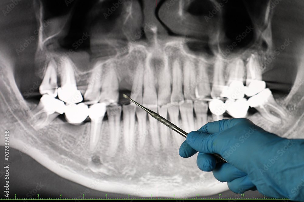 Φωτογραφία Hands of doctor dentist in gloves show the teeth on x-ray