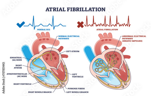 Atrial fibrillation as abnormal heart beat frequency disease outline diagram. Labeled educational scheme with cardiovascular condition and heart structure vector illustration. Anatomical explanation. photo