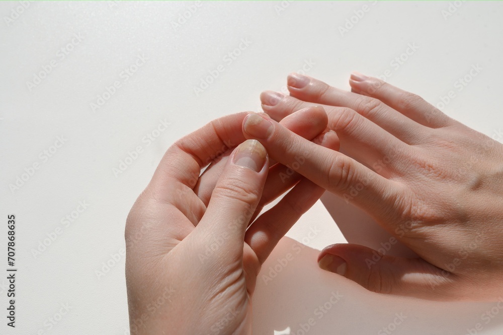 Hands with affected nails onycholysis. Separation of the nail plate from the nail bed after