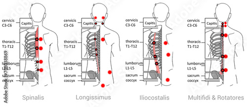 Tableau sur toile Iliocostalis, Longissimus  Spinalis, Multifidi & Rotatores: Myofascial trigger p