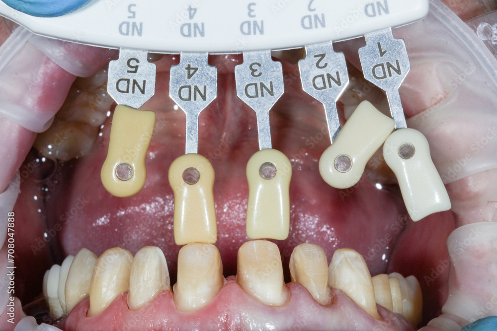 Anterior tooth preparation for dental crown buildup. Scale for
