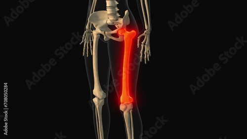 Medical animation of the femur bone pain photo