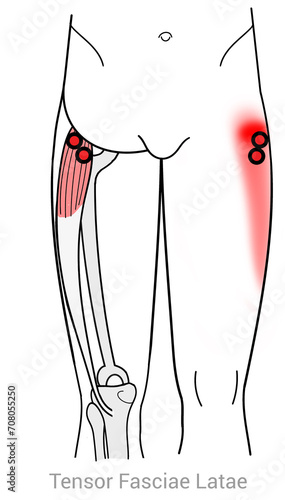 Slika na platnu Tensor Fasciae Latae: Myofascial trigger points and associated pain locations