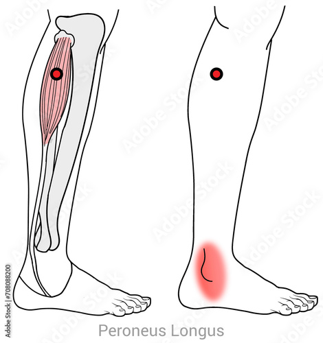 Peroneus Longus: Myofascial trigger points and associated pain locations photo