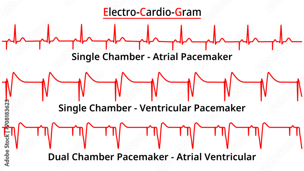 Set of ECG Common Abnormalities - Single vs Dual Chamber Pacemaker - Atrial Ventricular Rhythm - Electrocardiogram Vector Medical Illustration