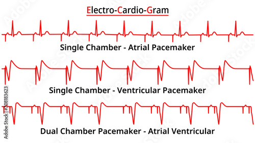 Set of ECG Common Abnormalities - Single vs Dual Chamber Pacemaker - Atrial Ventricular Rhythm - Electrocardiogram Vector Medical Illustration