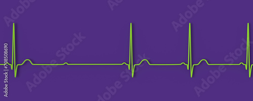 An ECG with 2nd degree Mobitz 2 AV block, 3D illustration photo