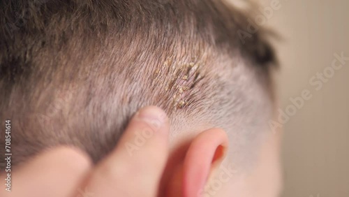 Host formation on the scalp of babies, host disease on the scalp,