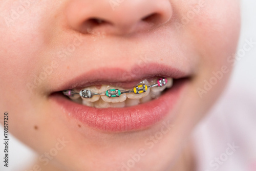 Little girl with rainbow braces