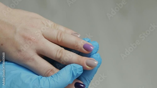 A doctor in a rubber glove examines a finger with a purulent abscess. Paronychia is an inflammation of the periarticular roller. Treatment of dermatological inflammations. photo