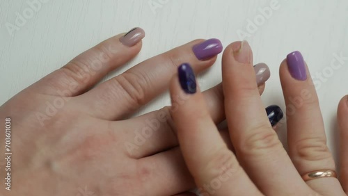 A fungal nail disease is a finger with pus in the nail roller. Partial absence of a nail on the other hand. The second stage of the disease is paronychia.