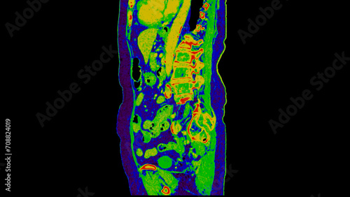 CT scan of  Abdomen  sagittal view with injection contrast media with green color mode coronal view for diagnosis  abdominal diseases. photo