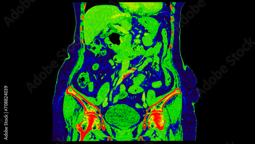 CT scan of  Abdomen  coronal view with injection contrast media with green color mode coronal view for diagnosis  abdominal diseases. photo
