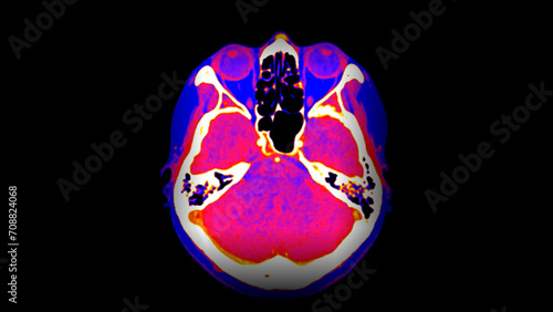 CT Brain Perfusion or CT scan image of the brain axial view .