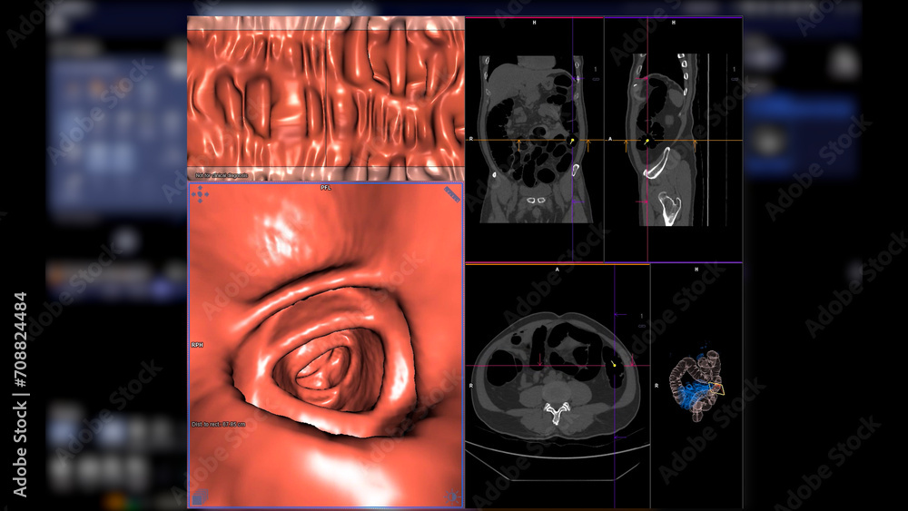 CT colonography , This imaging technique is often employed for colorectal cancer screening