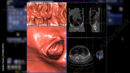 CT colonography , This imaging technique is often employed for colorectal cancer screening, providing detailed images of the colon's interior 3D rendering. photo